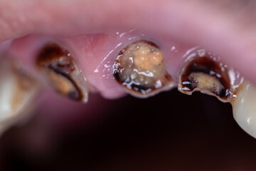 Rotten front teeth. Man without front upper teeth