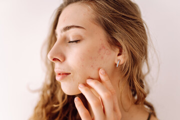 Portrait of a beautiful young woman with inflammations on the skin of her face. Pimples. Acne...