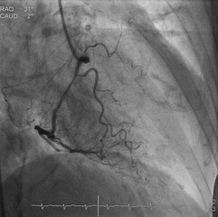 Coronary angiogram (CAG) was performed right coronary artery (RCA) stenosis.