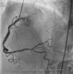 Coronary angiogram (CAG) was performed right coronary artery (RCA) stenosis.