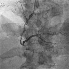 Coronary angiogram (CAG) was performed right coronary artery (RCA) stenosis.