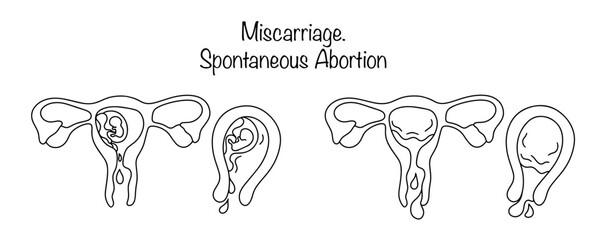 Fototapeta premium Miscarriage
