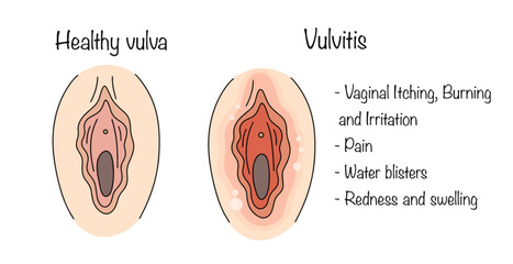 Vulvitis