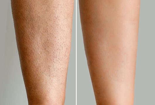 Image before and after woman's Legs hairs removal, skin care treatment for smooth skin concept.