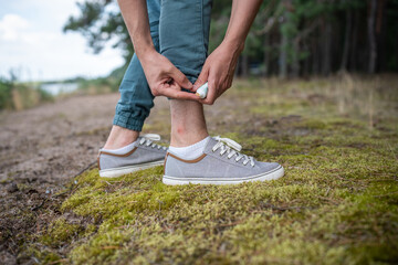 Male feet on grass, moss, man palms smearing fresh red painful mosquito bite with special product...