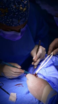 Usage of modern electric devices and metal tools at thyroid surgery. Top view on the surgeons cooperating at operation. Vertical video.