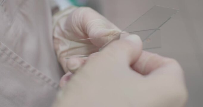 Lab technician applying a biopsy smear to a glass slide, close-up. Preparing material for oncological examination. A tumor biopsy is applied to a glass slide for examination under a microscope.