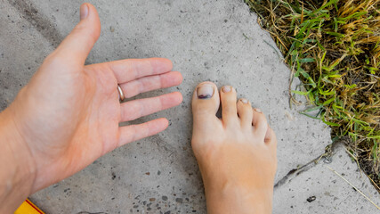 Caucasian person examining bruised toenail injury on concrete sidewalk, highlighting a painful walking-related accident or sports injury