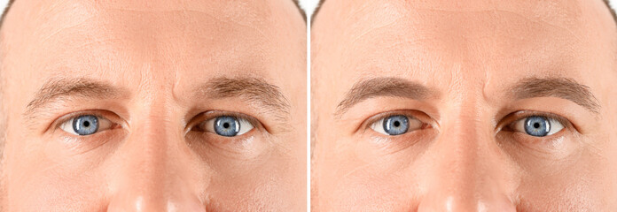 Man before and after permanent eyebrow procedure, collage with closeup photos