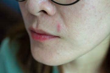 Cropped shot view of acne occur on Asian woman face. Allergies, irritants, genetic makeup, etc can...