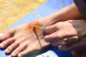 Close up of a wounded and itchy foot being dripped with red medicine