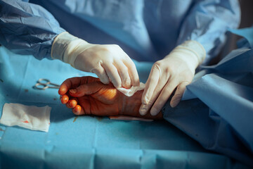 Doctor Uses Gauze to Stop Bleeding After Surgery Before Its Completion. Surgeon performing arm...