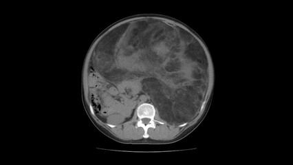 Abdomen liposarcoma, CT scan
