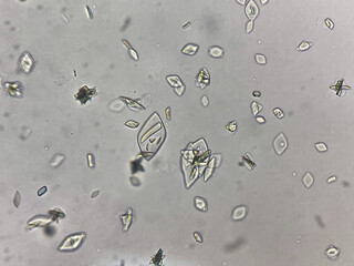 Uric acid crystal in urine sediment.