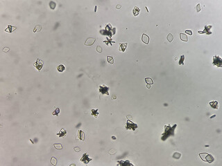 Uric acid crystal in urine sediment.