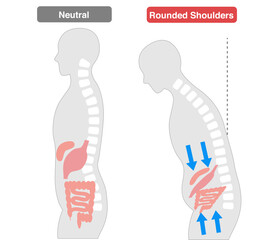 Comparison of people whose internal organs are compressed due to poor posture caused by a Rounded Shoulders.