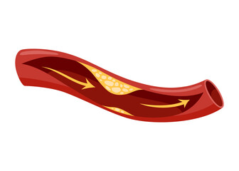 Atherosclerosis stage. Anatomy of heart attack. Arteriosclerotic vascular disease or ASVD. Atherosclerotic plaque in coronary artery. Vector illustration on white background