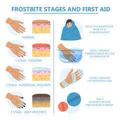 Frostbite infographic vector isolated. First aid and stages of hypothermia. Damaged fingers. Treatment of frostbitten area. Concept of health care, symptoms of frostbite.