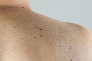Fototapeta premium Man with birthmarks on his skin against grey background, closeup