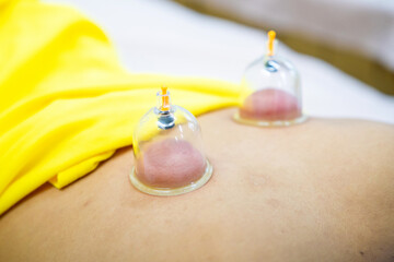 medical cupping therapy on human body. Wellness, health injury rehabilitation concept.