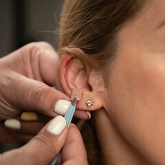 Ear acupressure, placing auriculotherapy seeds on female patient ear meridians