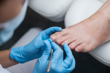 The podologist cleans the patient's nail using a curette tool. Patient on medical pedicure procedure, visiting podiatrist. Peeling feet. Foot treatment in SPA salon.Podiatry clinic