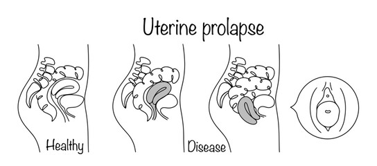 Uterine prolapse