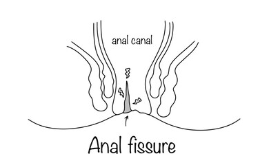 Anal fissure
