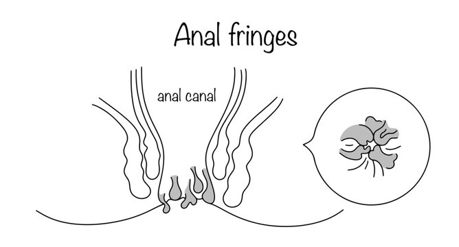 Anal fringes