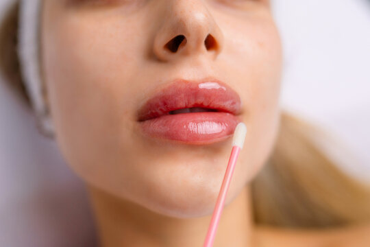 Injection procedure for lip augmentation, close-up. The cosmetologist slowly and carefully injects filler into the client lips. Advertising concept for facial care, youth and beauty