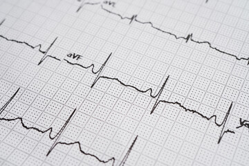 Electrocardiogram (ECG), heart wave, heart attack, cardiogram report.