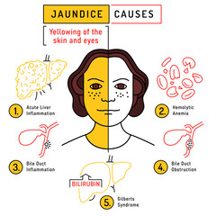Obraz premium Jaundice causes infographic in outline style. Yellowing of skin and eyes, caused by bilirubin buildup. Hyperbilirubinemia etiology. Medical concept. Vector illustration isolated on a white background