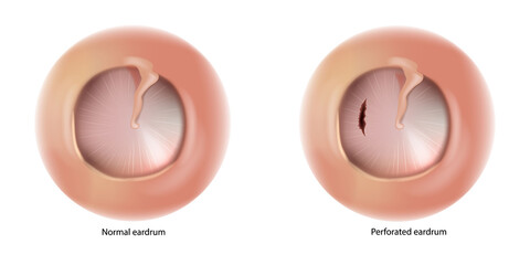 Perforated eardrum and Normal eardrum. Ruptured eardrum or Hole in the eardrum. 
