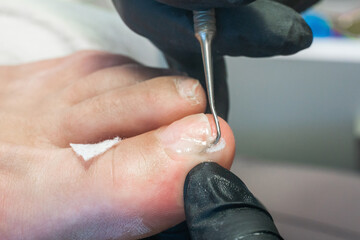 Medical pedicure, podiatrist doing tamponade to a deformed toenail