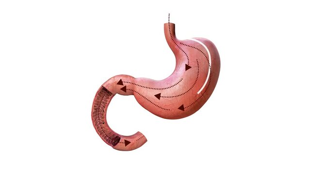 Biliopancreatic diversion with duodenal switch. BPD stomach surgery concept, weight loss gastric procedure. Abdomen laparoscopy. Overweight and obesity in human body flat medical Video 3d