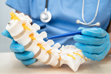 Doctor holding lumbar vertebrae spine skeleton bone and spinal nerve with displaced herniated disc...