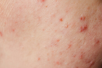 Fototapeta premium Skin acne background. Closeup acne pimple. Treatment for acne skin. Problem skincare. Pimples, acne, pores, scars. Natural skin. Skin care treatment. Pimples on face.