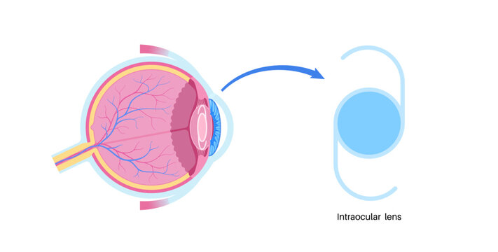 Intraocular lens poster