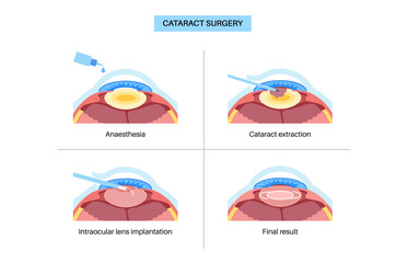 Cataract surgery poster