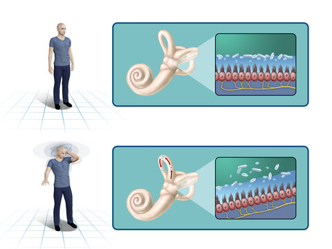 Benign paroxysmal positional vertigo