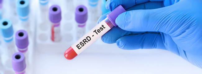 Obraz premium Doctor holding a test blood sample tube with ESRD test on the background of medical test tubes with analyzes.