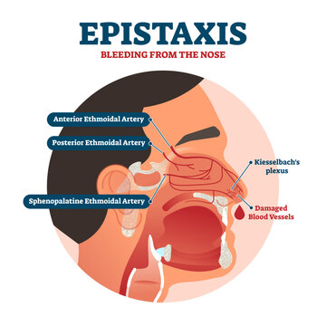 Epistaxis illustration, transparent background. Labeled bleeding from nose explanation health scheme. Educational Inner structure with artery, vessels and kiesselbach's plexus.