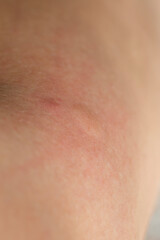 Inflamed human skin after a mosquito bite. 