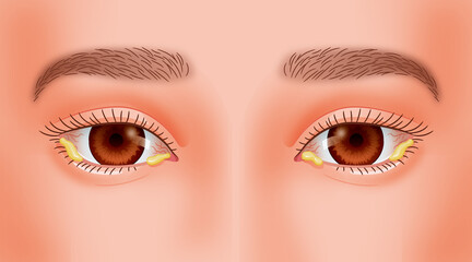 目やにが出ている目