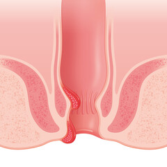 外痔核と内痔核