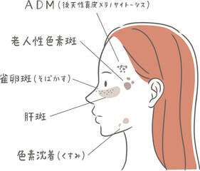シミの種類と横顔の女性のイラスト素材