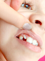Close-up of the upper jaw and first teeth. The child shows a problematic uneven tooth. Treatment, bite correction, braces. Dentistry concept © Alina