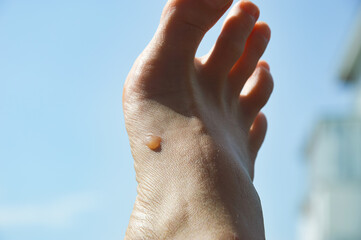 a callus on a woman's foot. human foot, fingers. a body part. background for the design.