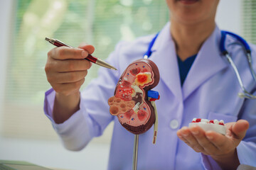 Doctor holding kidney medicine model