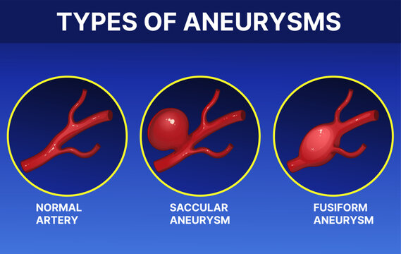 Types of aneurysms. Infographic. Healthcare illustration. Vector illustration.